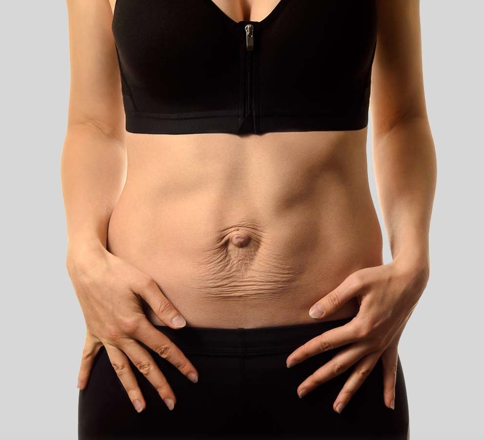 Diástasis abdominal en Chamberí